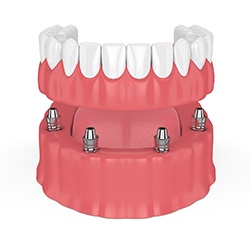 Model of All-On-4 denture.