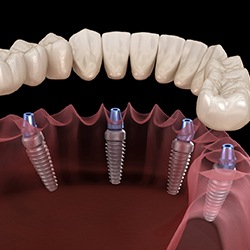 Digital image of All-On-4 implants. 