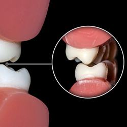 model of teeth grinding against each other