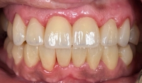 Bright white smile after teeth whitening