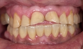 Yellow and discolored smile before teeth whitening