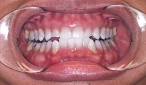 Bright white smile after teeth whitening