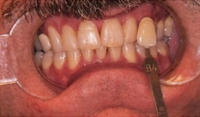Closeup yellow teeth before whitening