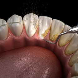 Digital image of a dental cleaning being done