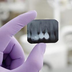 Dental x-ray of dental implants