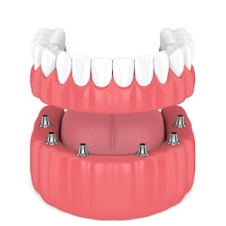 Digital model of implant retained denture