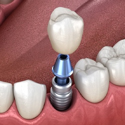 single dental implant supporting a crown