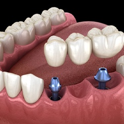 two dental implants supporting a dental bridge