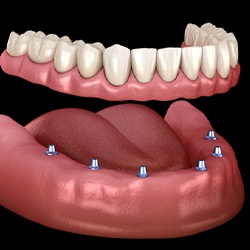 six dental implants supporting a full denture