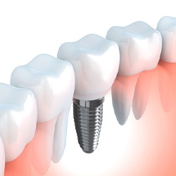 mini dental implant in lower arch