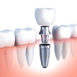 dental implant with a crown