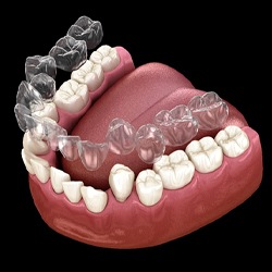 A digital image of an Invisalign aligner preparing to go on over a row of crooked teeth