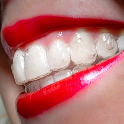 A close view of an Invisalign aligner snugly fitting against a person’s upper row of teeth