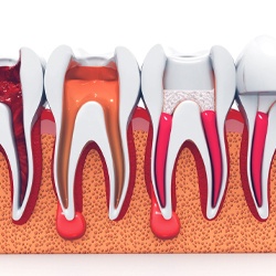 root canal procedure