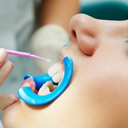 child getting dental sealants applied to their molars