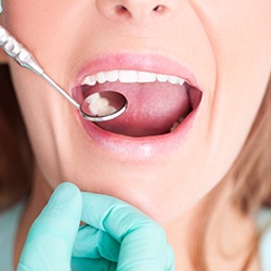 Closeup of smile during dental exam