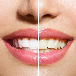 A smile before and after teeth whitening