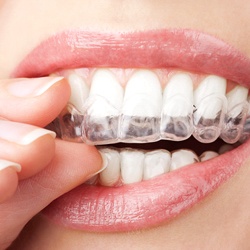 A woman putting in a whitening tray